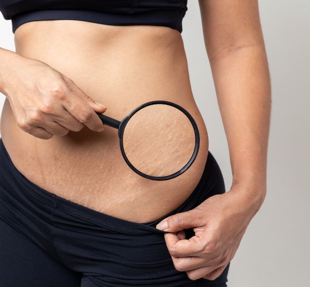 Stretch Marks
